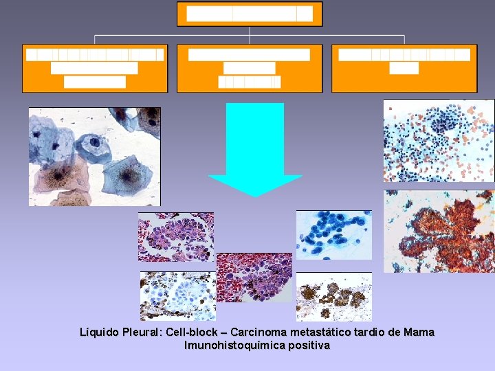 Líquido Pleural: Cell-block – Carcinoma metastático tardio de Mama Imunohistoquímica positiva 