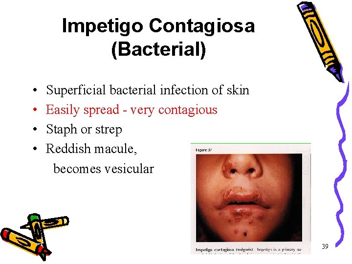 Impetigo Contagiosa (Bacterial) • Superficial bacterial infection of skin • Easily spread - very Impetigo Contagiosa (Bacterial) • Superficial bacterial infection of skin • Easily spread - very