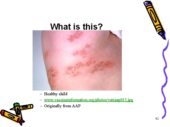What is this? – Healthy child – www. vaccineinformation. org/photos/variaap 015. jpg – Originally What is this? – Healthy child – www. vaccineinformation. org/photos/variaap 015. jpg – Originally