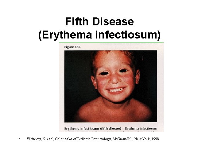 Fifth Disease (Erythema infectiosum) • Weinberg, S. et al, Color Atlas of Pediatric Dermatology, Fifth Disease (Erythema infectiosum) • Weinberg, S. et al, Color Atlas of Pediatric Dermatology,