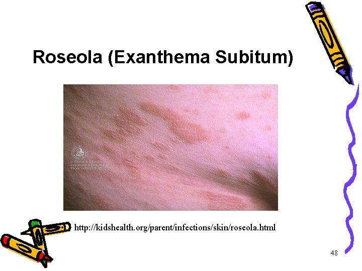 Roseola (Exanthema Subitum) • http: //kidshealth. org/parent/infections/skin/roseola. html 48 Roseola (Exanthema Subitum) • http: //kidshealth. org/parent/infections/skin/roseola. html 48