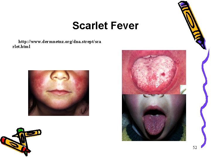 Scarlet Fever http: //www. dermnetnz. org/dna. strept/sca rlet. html 52 Scarlet Fever http: //www. dermnetnz. org/dna. strept/sca rlet. html 52