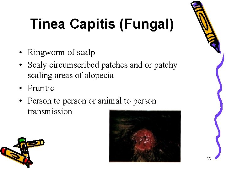 Tinea Capitis (Fungal) • Ringworm of scalp • Scaly circumscribed patches and or patchy Tinea Capitis (Fungal) • Ringworm of scalp • Scaly circumscribed patches and or patchy