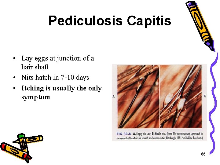 Pediculosis Capitis • Lay eggs at junction of a hair shaft • Nits hatch Pediculosis Capitis • Lay eggs at junction of a hair shaft • Nits hatch