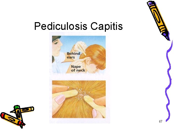Pediculosis Capitis 67 Pediculosis Capitis 67