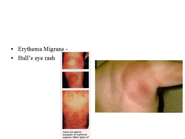 • Erythema Migrans • Bull’s eye rash • Erythema Migrans • Bull’s eye rash