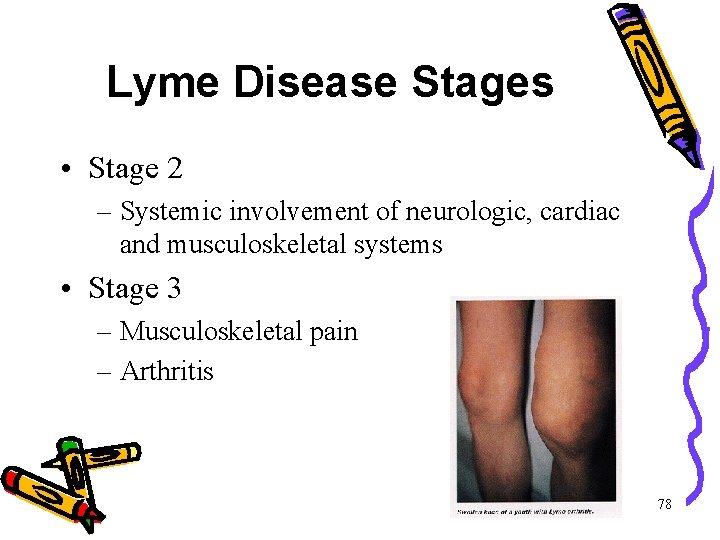 Lyme Disease Stages • Stage 2 – Systemic involvement of neurologic, cardiac and musculoskeletal Lyme Disease Stages • Stage 2 – Systemic involvement of neurologic, cardiac and musculoskeletal