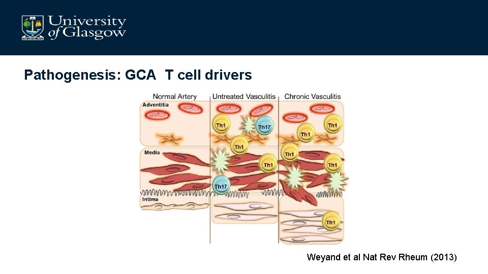 Pathogenesis: GCA T cell drivers Weyand et al Nat Rev Rheum (2013) 