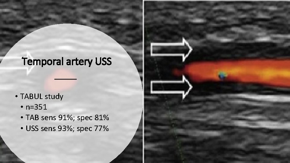 Temporal artery USS • TABUL study • n=351 • TAB sens 91%; spec 81%