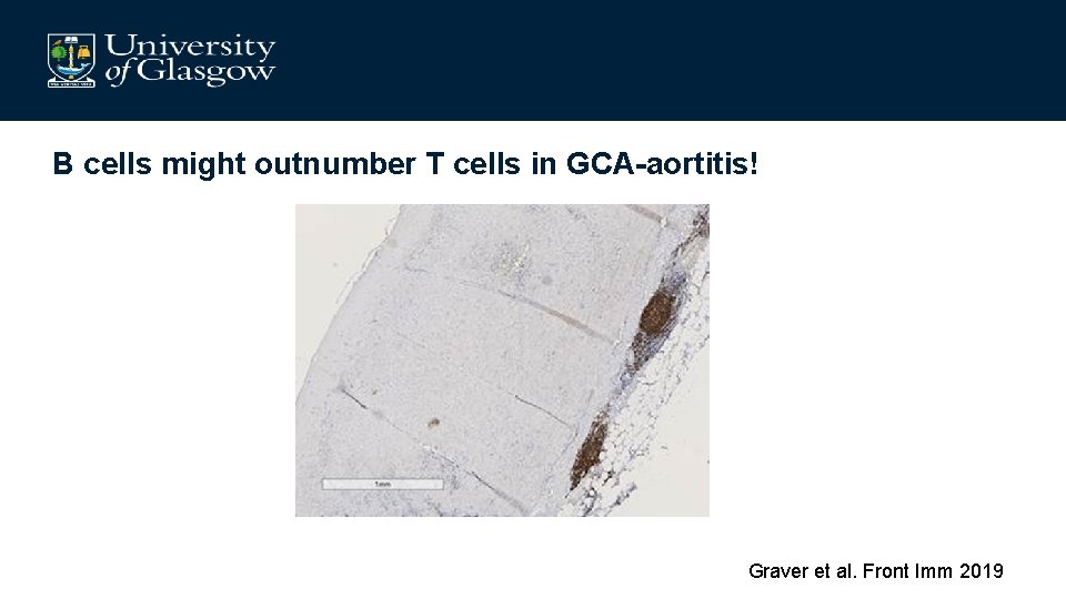 B cells might outnumber T cells in GCA-aortitis! Graver et al. Front Imm 2019