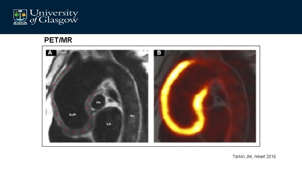 PET/MR Tarkin JM, Heart 2016 
