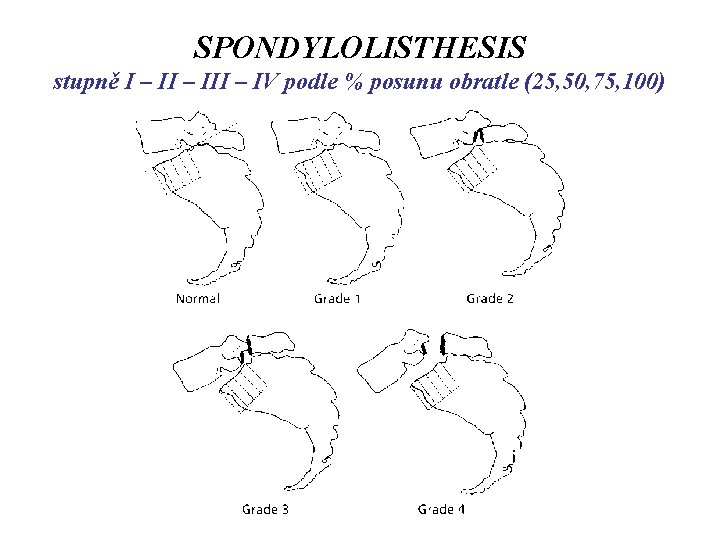 SPONDYLOLISTHESIS stupně I – III – IV podle % posunu obratle (25, 50, 75,