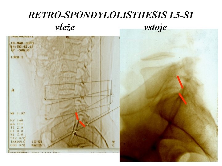 RETRO-SPONDYLOLISTHESIS L 5 -S 1 vleže vstoje 
