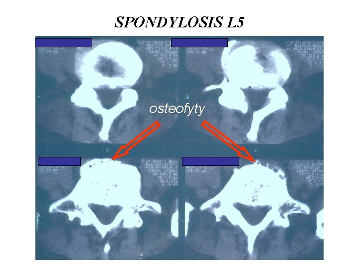 SPONDYLOSIS L 5 osteofyty 