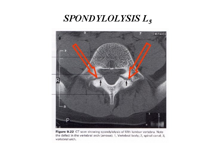 SPONDYLOLYSIS L 5 