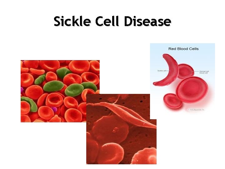 Sickle Cell Disease 