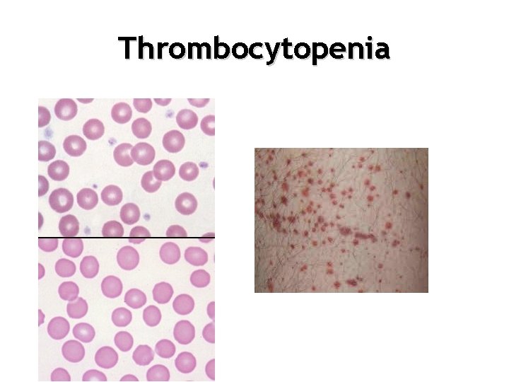 Thrombocytopenia 