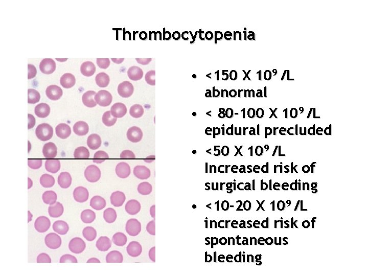 Thrombocytopenia • <150 X 109 /L abnormal • < 80 -100 X 109 /L