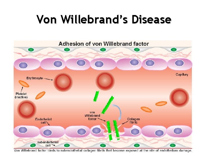 Von Willebrand’s Disease 