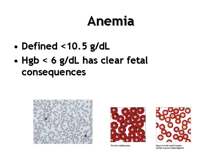 Anemia • Defined <10. 5 g/d. L • Hgb < 6 g/d. L has