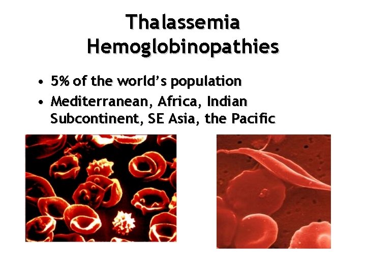 Thalassemia Hemoglobinopathies • 5% of the world’s population • Mediterranean, Africa, Indian Subcontinent, SE