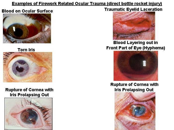 Examples of Firework Related Ocular Trauma (direct bottle rocket injury) Traumatic Eyelid Laceration Blood