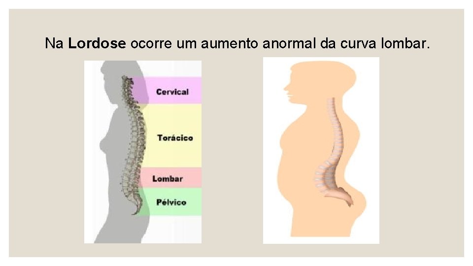  Na Lordose ocorre um aumento anormal da curva lombar. 