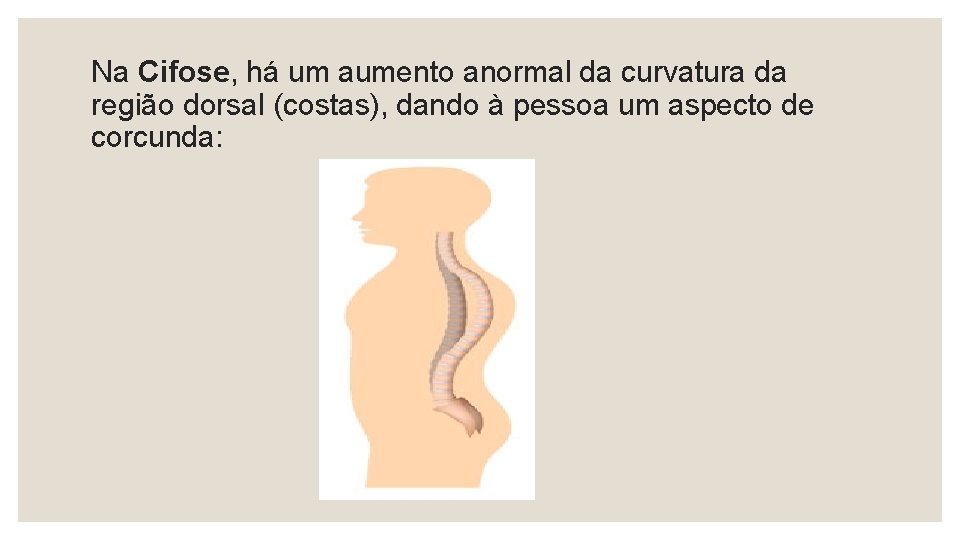  Na Cifose, há um aumento anormal da curvatura da região dorsal (costas), dando