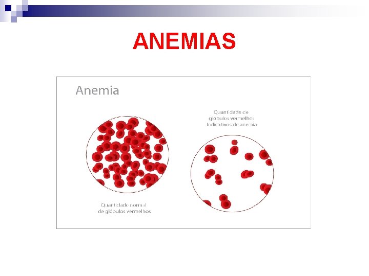 ANEMIAS 