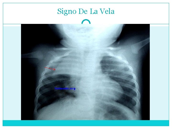 Signo De La Vela 