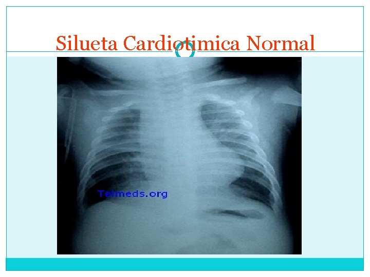 Silueta Cardiotimica Normal 