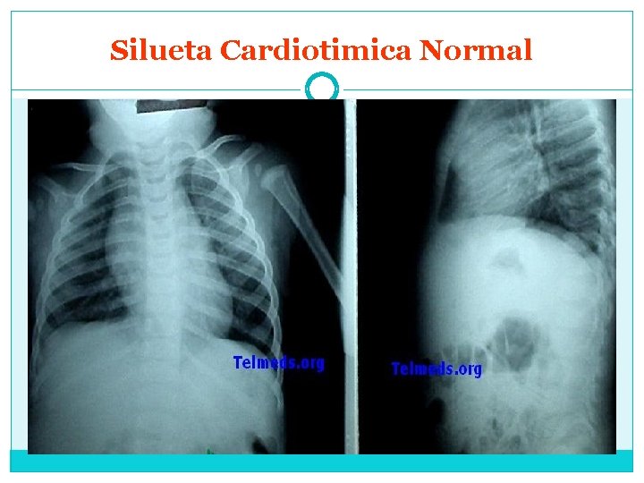 Silueta Cardiotimica Normal 