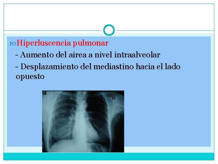  Hiperluscencia pulmonar - Aumento del airea a nivel intraalveolar - Desplazamiento del mediastino