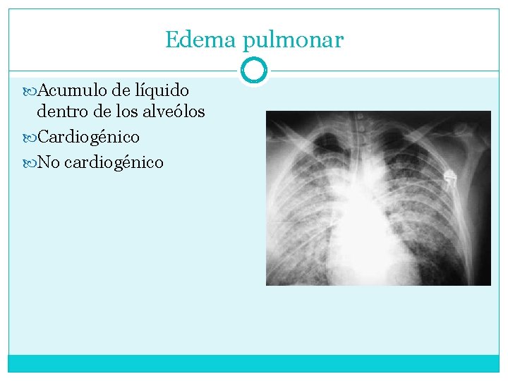 Edema pulmonar Acumulo de líquido dentro de los alveólos Cardiogénico No cardiogénico 