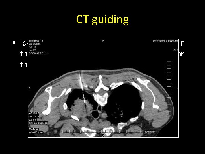 CT guiding • Ideal method if the lesion is located either in the chest, CT guiding • Ideal method if the lesion is located either in the chest,