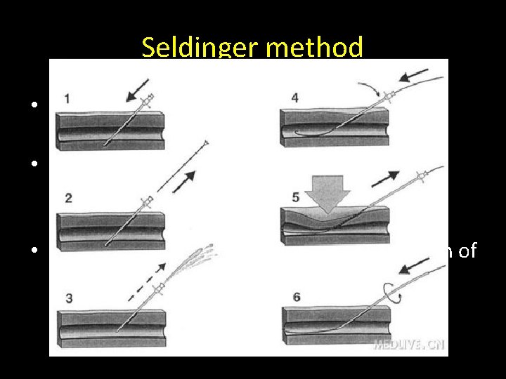 Seldinger method • US or CT guided puncture of the lesion is performed with Seldinger method • US or CT guided puncture of the lesion is performed with