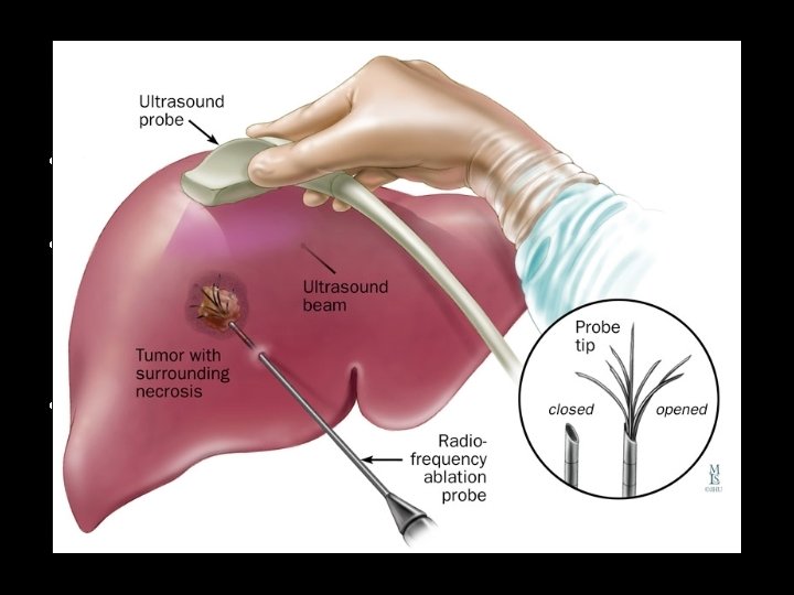 Radiofrequency ablation (RFA) • During RF ablation an electrode is positioned in the tumor. Radiofrequency ablation (RFA) • During RF ablation an electrode is positioned in the tumor.