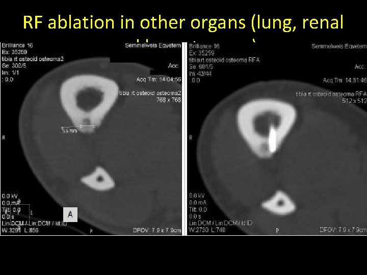 RF ablation in other organs (lung, renal and bone tumors) • Bone – The RF ablation in other organs (lung, renal and bone tumors) • Bone – The