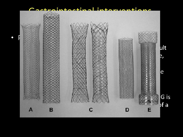 Gastrointestinal interventions, endoluminal stent implantations • Percutaneous gastrostomy – In case of swallowing impairment Gastrointestinal interventions, endoluminal stent implantations • Percutaneous gastrostomy – In case of swallowing impairment