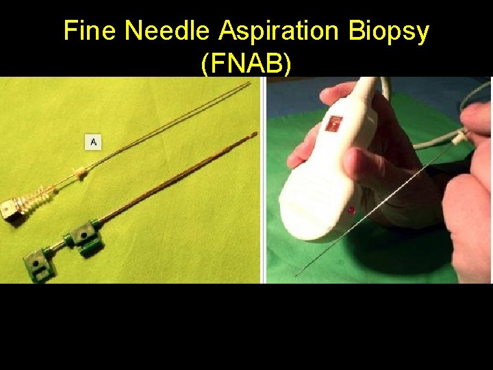 Fine Needle Aspiration Biopsy (FNAB) • With 20 G or thinner needles one can Fine Needle Aspiration Biopsy (FNAB) • With 20 G or thinner needles one can