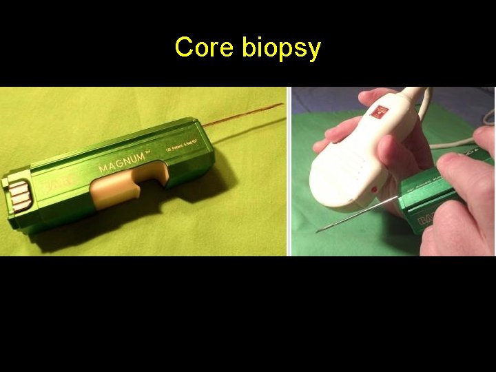 Core biopsy • Most often we use 14 -18 G needles for these tissue Core biopsy • Most often we use 14 -18 G needles for these tissue