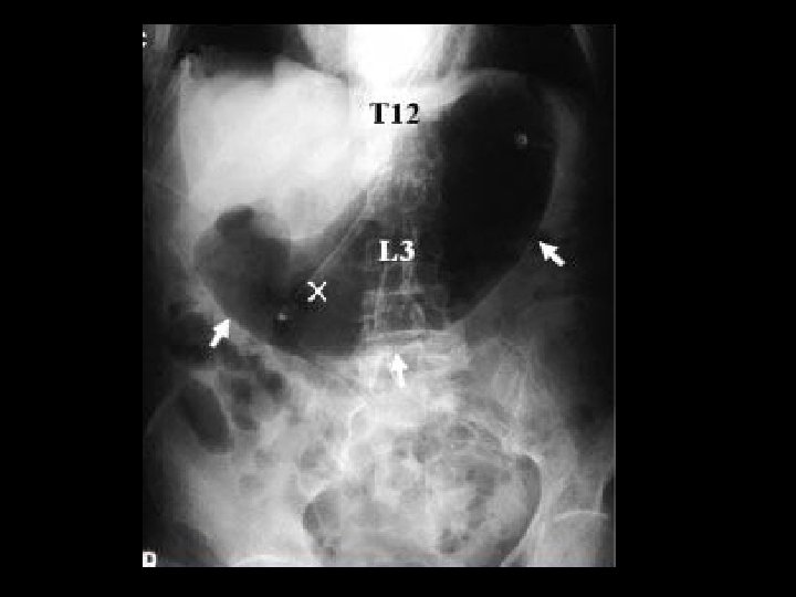 X-ray guiding X-ray guiding