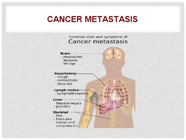 CANCER METASTASIS 