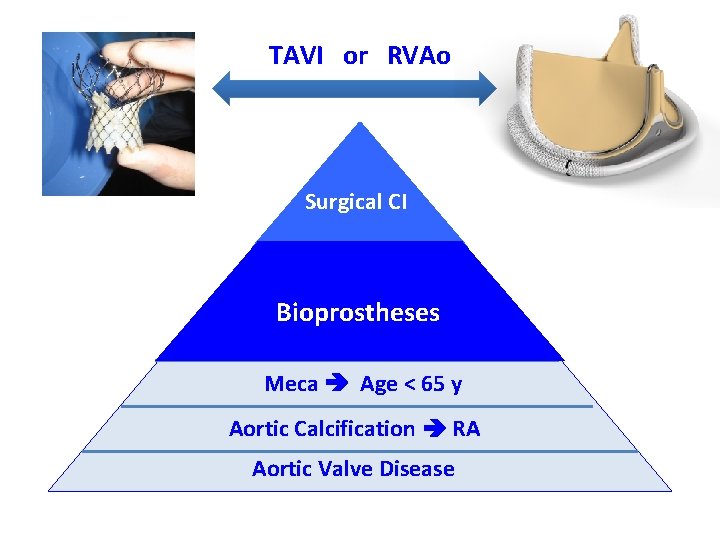 TAVI or RVAo Surgical CI Bioprostheses Meca Age < 65 y Aortic Calcification RA