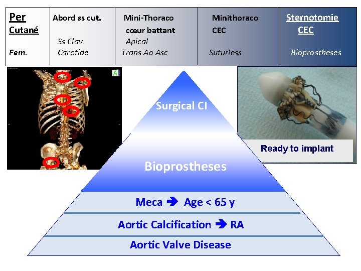 Per Mini-Thoraco Minithoraco Sternotomie Cutané cœur battant CEC Ss Clav Apical Fem. Carotide Trans