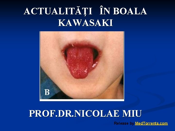 ACTUALITĂŢI ÎN BOALA KAWASAKI PROF. DR. NICOLAE MIU Release by Med. Torrents. com 