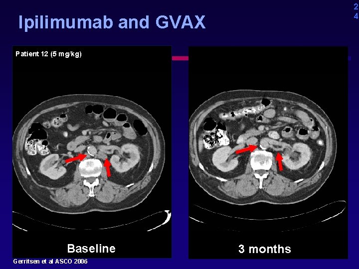 2 4 Ipilimumab and GVAX Patient 12 (5 mg/kg) Baseline Gerritsen et al ASCO