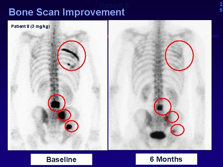 2 5 Patient 8 Bone Scan Improvement Patient 8 (3 mg/kg) Baseline 6 Months