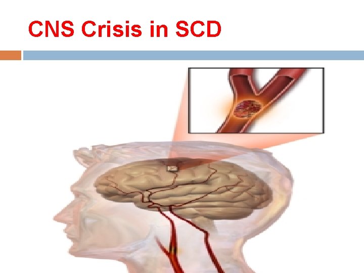 CNS Crisis in SCD 