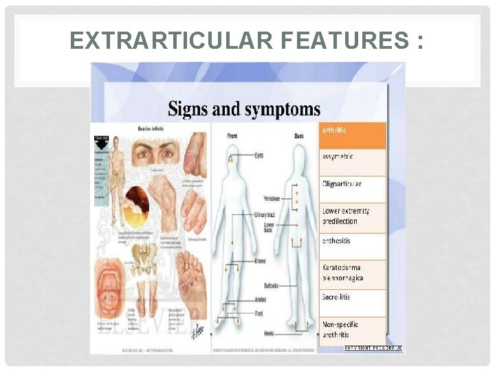 EXTRARTICULAR FEATURES : 